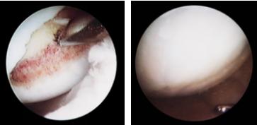Arthroskopische Betrachtung der Abrasion auf dem medialen Femurcondylus und Kontrollarthroskopie zeigt den nachgewachsenen Knorpel.